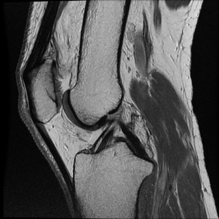 Anomalous insertion of the medial meniscus | Image | Radiopaedia.org