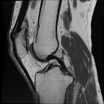 Radial meniscal tear | Radiology Reference Article | Radiopaedia.org