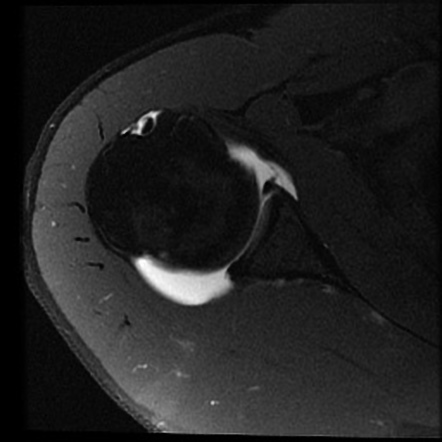 Perthes lesion and SLAP tear | Radiology Case | Radiopaedia.org