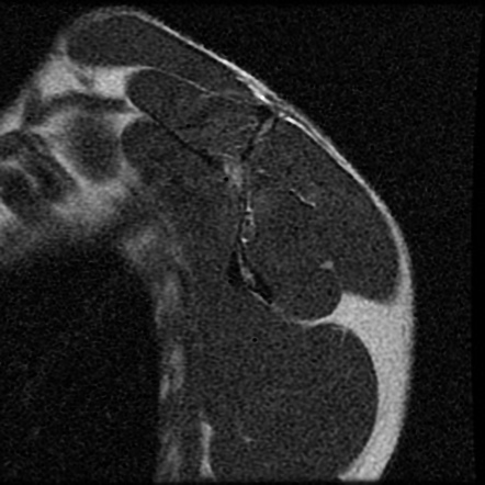 Perthes lesion and SLAP tear | Radiology Case | Radiopaedia.org