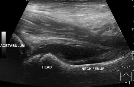 Hip Septic Arthritis (pediatric) 