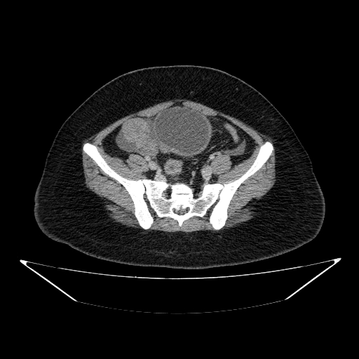 Ovarian Torsion With Serous Cystadenoma Image