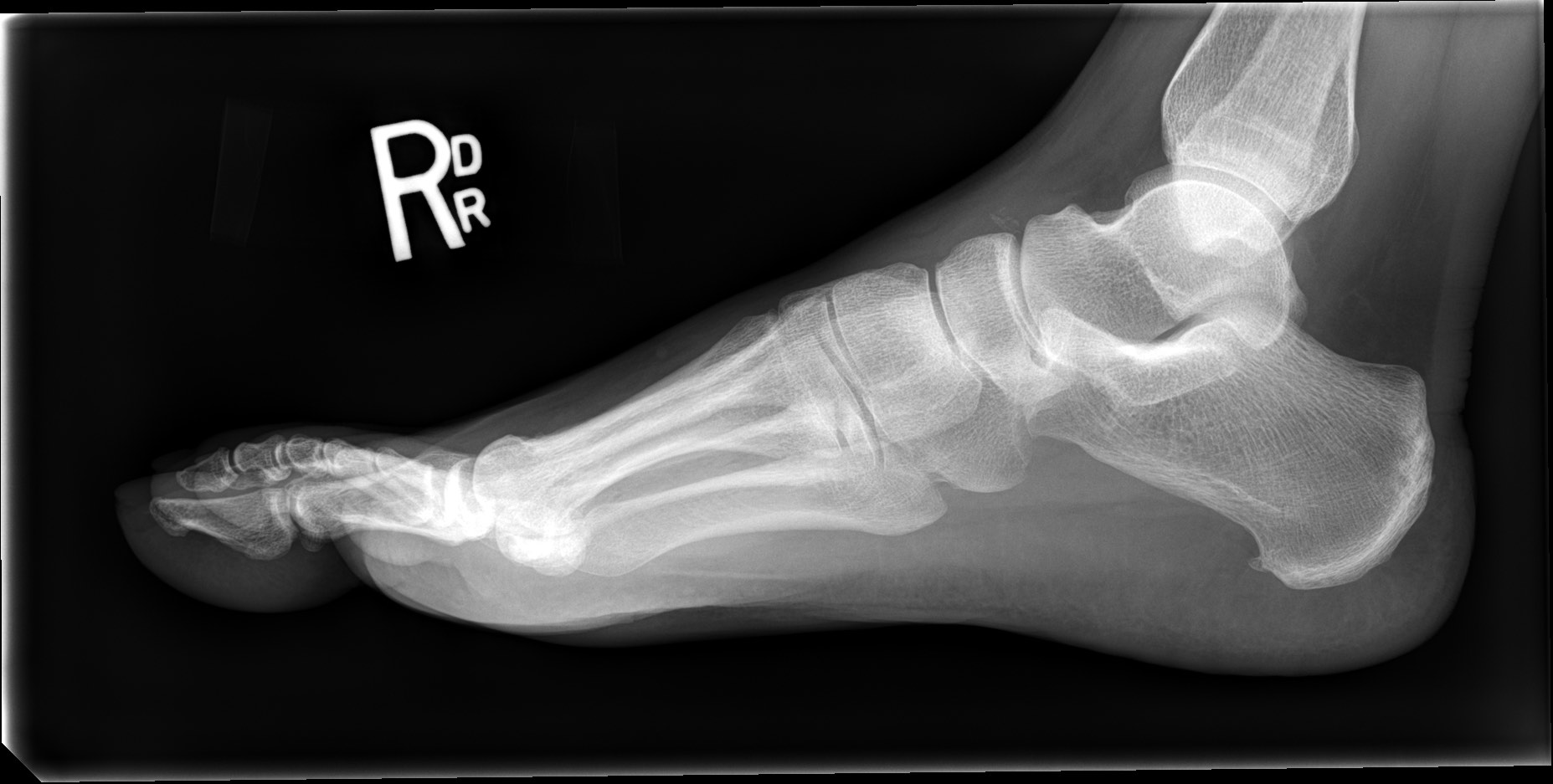 Chopart injury | Image | Radiopaedia.org