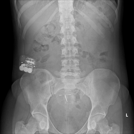 Medical devices in the abdomen and pelvis | Radiology Reference Article ...