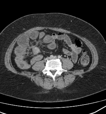 Small bowel neuroendocrine tumor | Radiology Reference Article ...