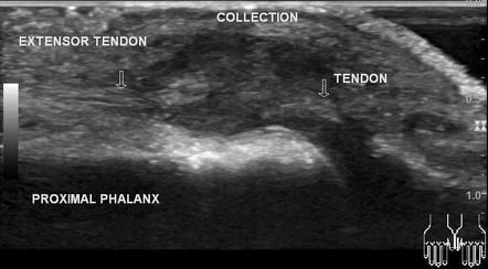 Extensor pollicis longus tendon injury | Radiology Case | Radiopaedia.org