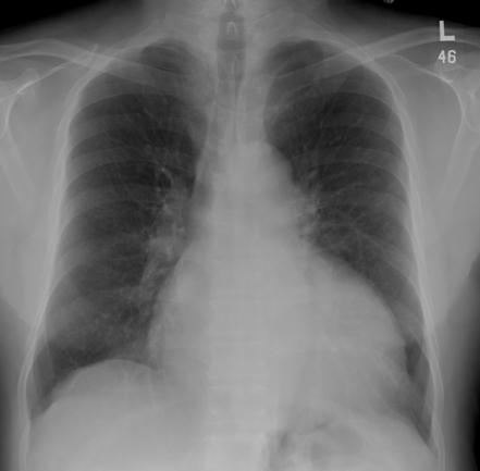 File:Dilated cardiomyopathy B-Mode.jpg - Wikipedia