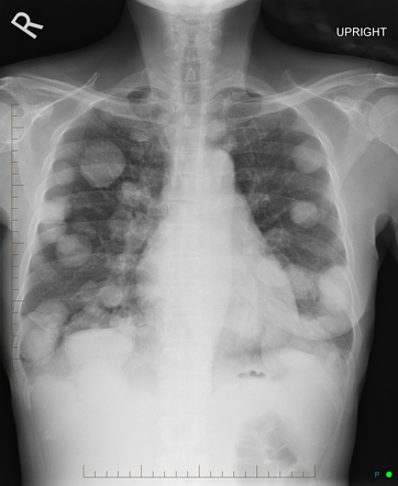 Canonball lung metastasis | Image | Radiopaedia.org