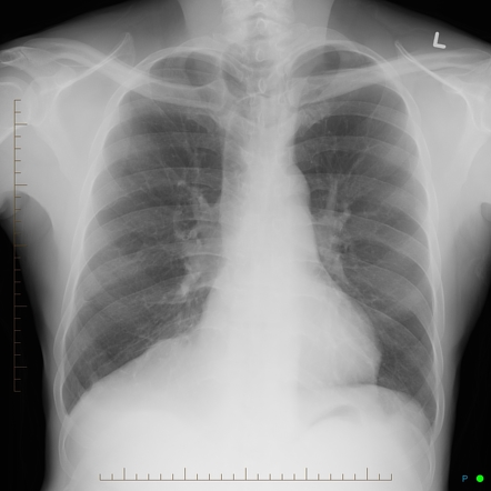 Mounier-Kuhn disease | Image | Radiopaedia.org