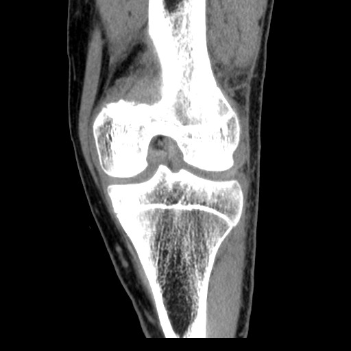 Lateral patellar dislocation with lipohemarthrosis on ultrasound ...