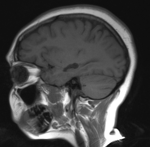 Choroidal Fissure Cyst Image 