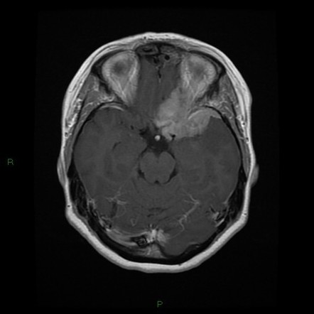 Meningioma | Radiology Reference Article | Radiopaedia.org