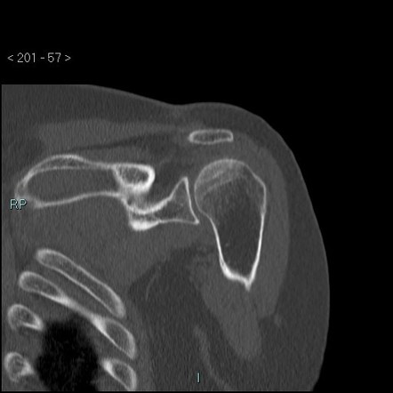 Avascular necrosis of the shoulder - Cruess stage I | Image ...