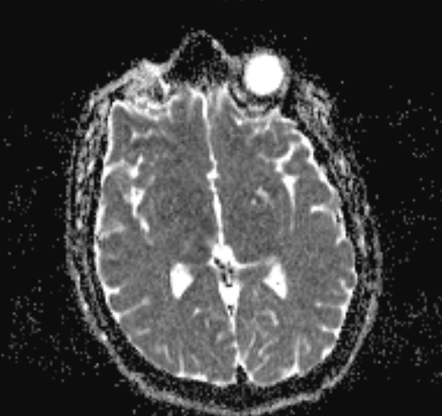 Acute Ischemic Stroke Posterior Circulation Territory Image