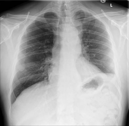 Metastatic testicular seminoma | Radiology Case | Radiopaedia.org