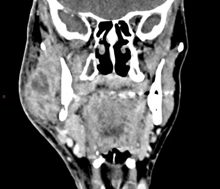 Mandibular osteomyelitis due to chronic dental abscess | Radiology Case ...