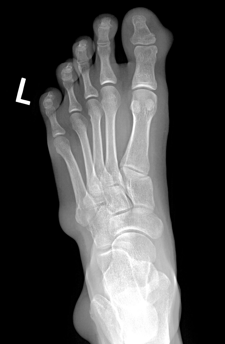 Ankle tendons xanthomas | Image | Radiopaedia.org