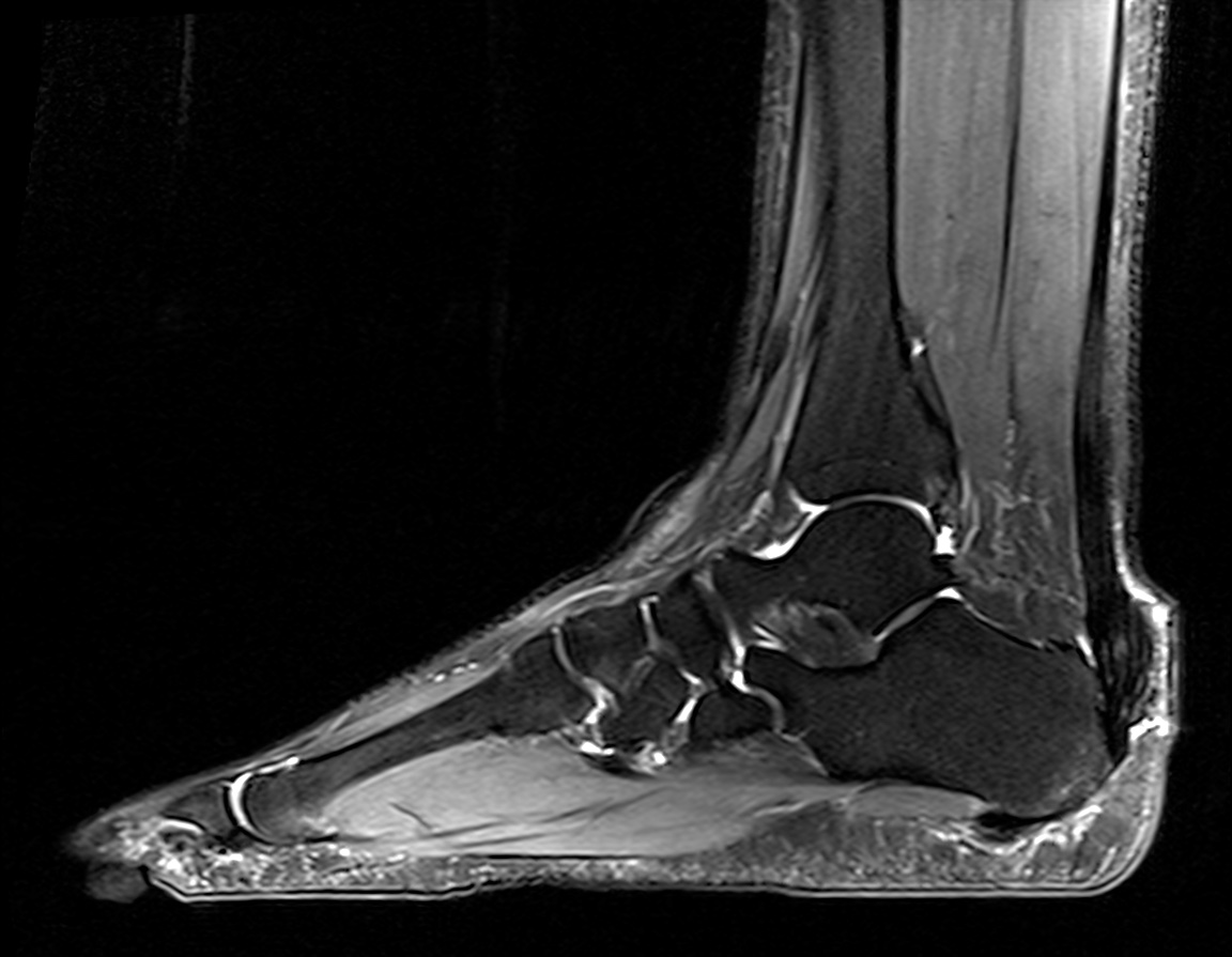 Ankle tendons xanthomas | Image | Radiopaedia.org