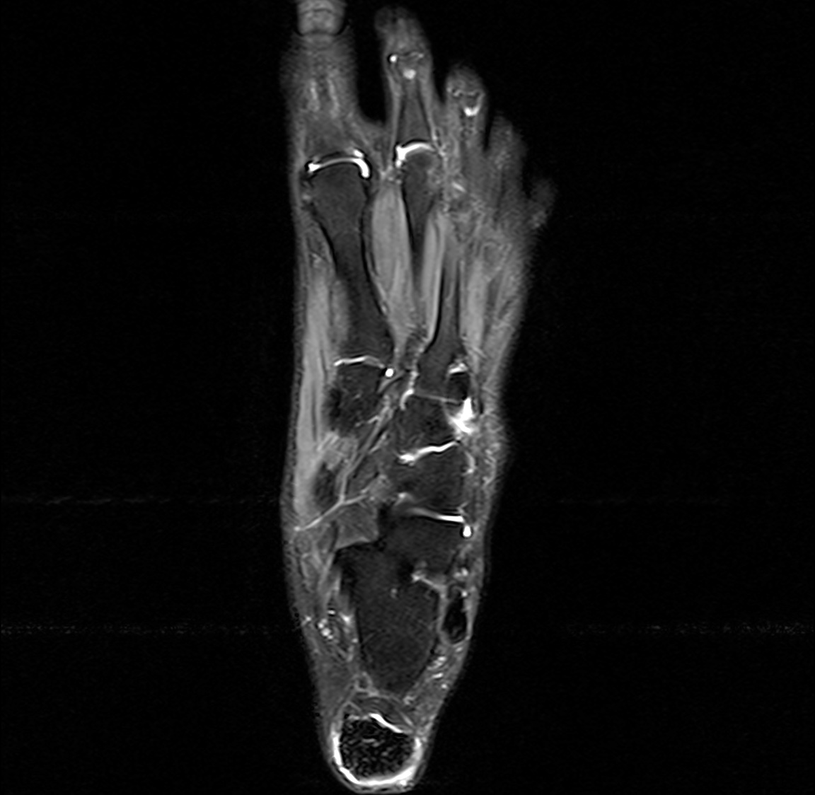 Ankle tendons xanthomas | Image | Radiopaedia.org