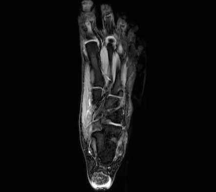 Ankle tendons xanthomas | Image | Radiopaedia.org