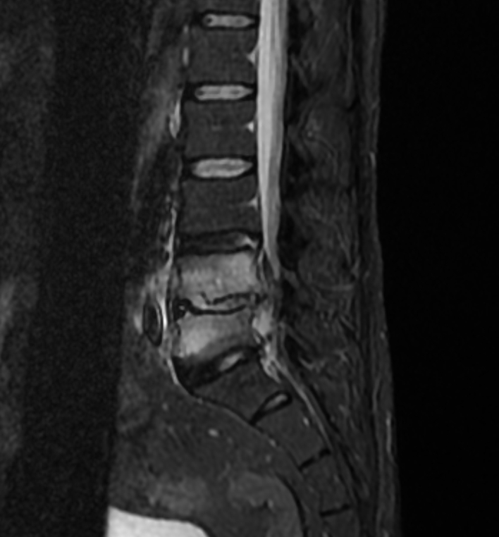 Brucella spondylodiscitis | Image | Radiopaedia.org