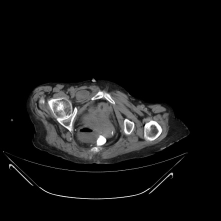 Obturator Hernia Radiology Case Radiopaedia Org