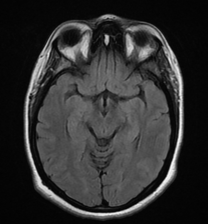 Idiopathic intracranial hypertension (IIH) | Image | Radiopaedia.org