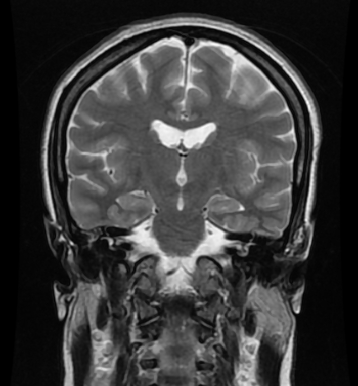 Idiopathic intracranial hypertension (IIH) | Image | Radiopaedia.org