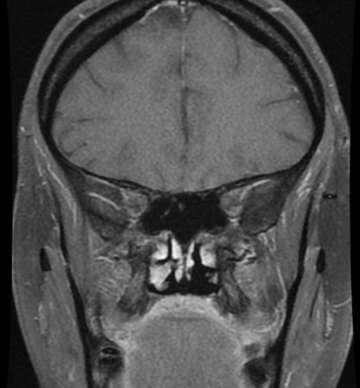 Idiopathic Intracranial Hypertension Iih Image 6526