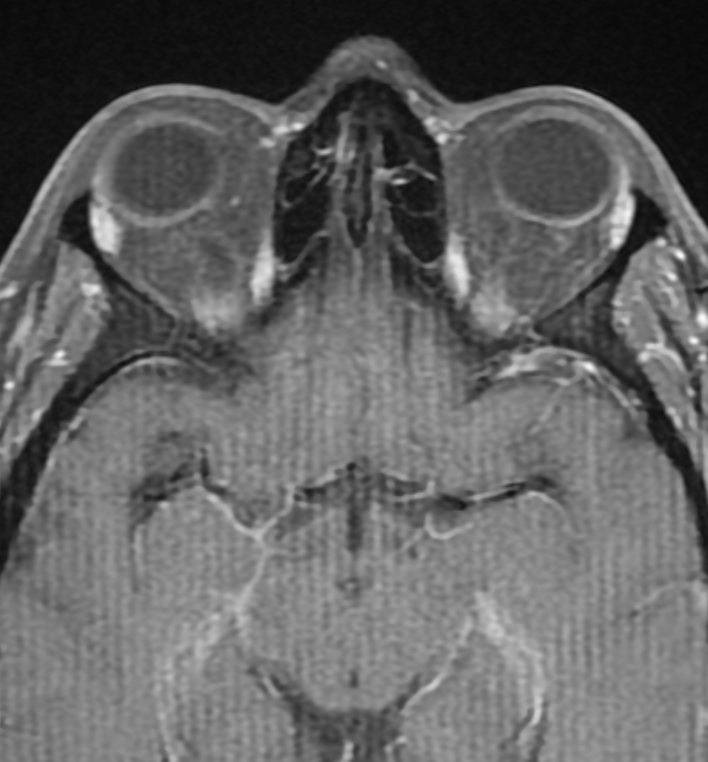 Idiopathic intracranial hypertension (IIH) | Image | Radiopaedia.org