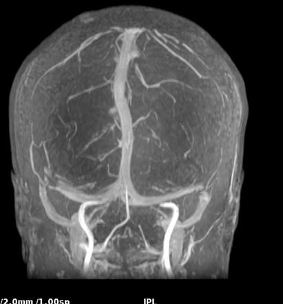 Idiopathic Intracranial Hypertension (IIH) | Image | Radiopaedia.org