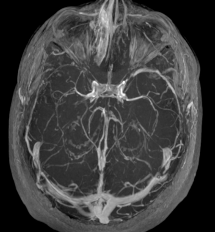 Idiopathic intracranial hypertension (IIH) | Image | Radiopaedia.org