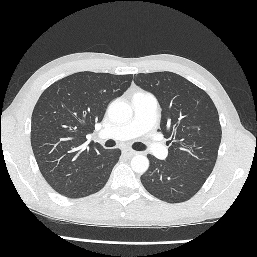 Macklin effect | Image | Radiopaedia.org