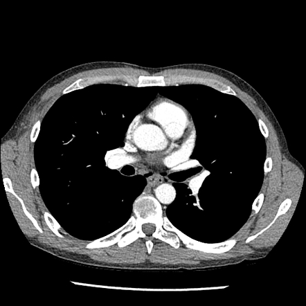 Macklin effect | Image | Radiopaedia.org