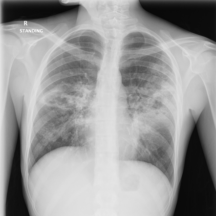 Pulmonary tuberculosis | Radiology Case | Radiopaedia.org