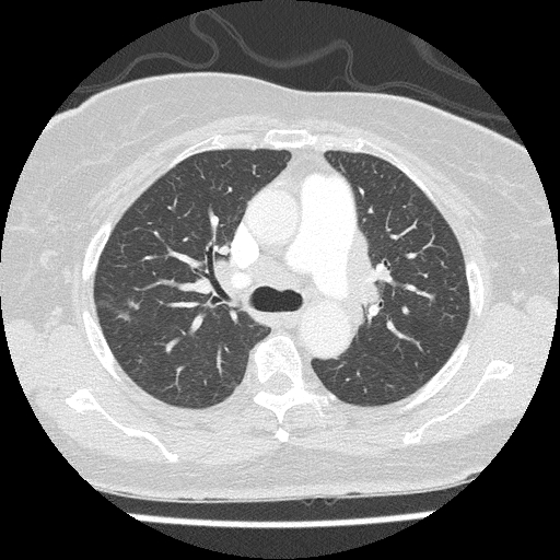 Sarcoidosis stage II | Image | Radiopaedia.org