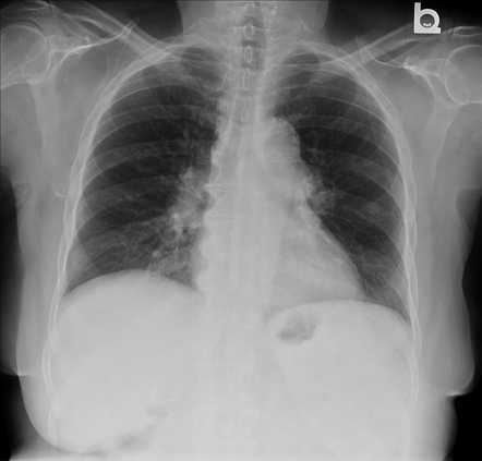 Sarcoidosis stage II | Radiology Case | Radiopaedia.org