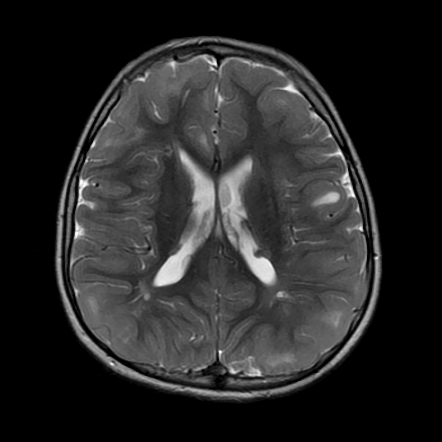 Tuberous sclerosis | Image | Radiopaedia.org