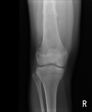 Femoral osteosarcoma | Radiology Case | Radiopaedia.org