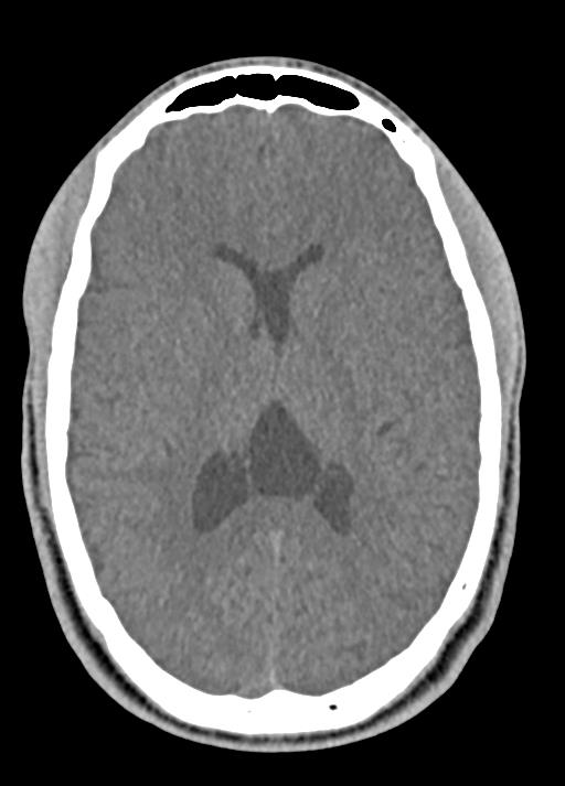 Cavum septum pellucidum and cavum vergae | Image | Radiopaedia.org