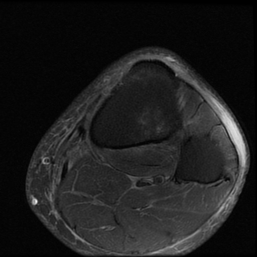 File:Multi-ligamentous knee injury - ACL, MCL, fibular collateral ...