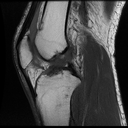 Multi-ligamentous knee injury - ACL, MCL, fibular collateral | Image ...