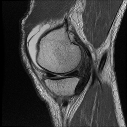 File:Multi-ligamentous knee injury - ACL, MCL, fibular collateral ...