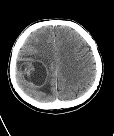 Glioblastoma with pseudoresponse | Image | Radiopaedia.org