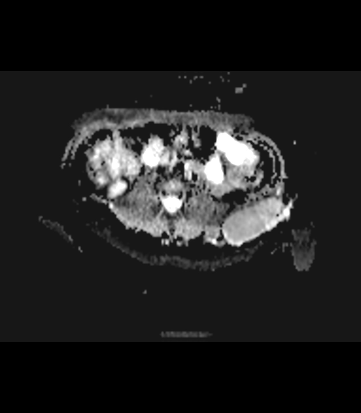 Desmoid-type Fibromatosis | Image | Radiopaedia.org