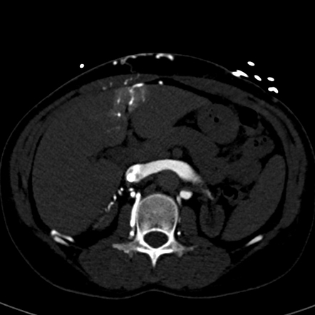 Focal hepatic hot spot sign (SVC obstruction) | Radiology Case ...