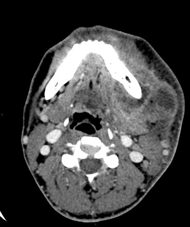 Odontogenic abscess | Radiology Case | Radiopaedia.org