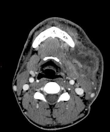 Dental abscess | Radiology Reference Article | Radiopaedia.org