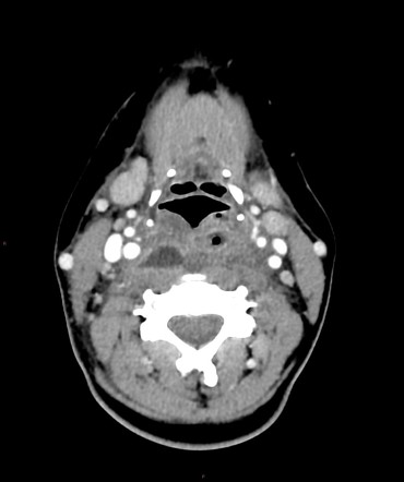 Retropharyngeal abscess with peritonsillar origin | Image | Radiopaedia.org