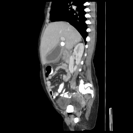 Acute Cholecystitis | Radiology Reference Article | Radiopaedia.org